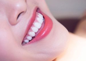 răng sứ lava plus