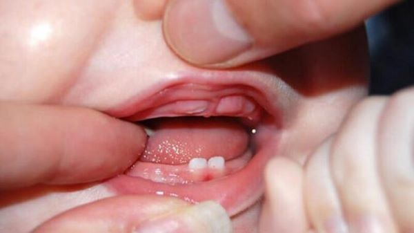 Những biểu hiện sốt mọc răng ở trẻ là gì?