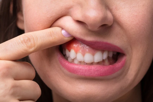 Sưng mộng răng là tình trạng viêm lợi cấp độ nặng