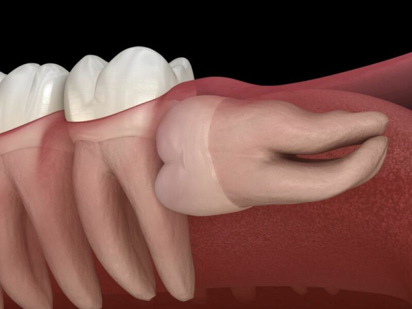 Răng khôn mọc ngang gây đau đớn cho bệnh nhân