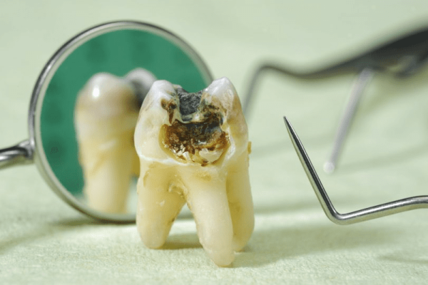 Sâu răng khôn khiến việc điều trị trở nên phức tạp