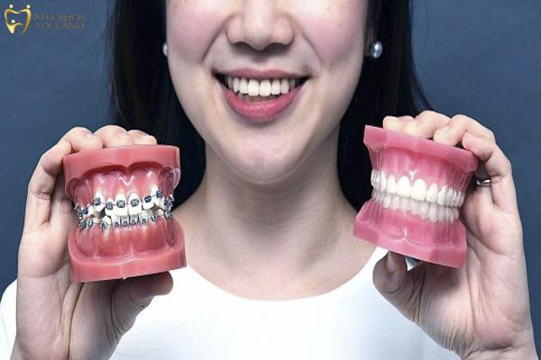 Khi nào nên nẹp răng?