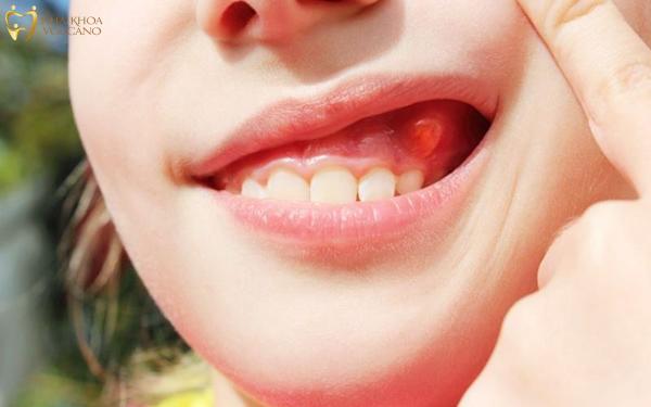 Các vị trí sưng nướu răng thường gặp
