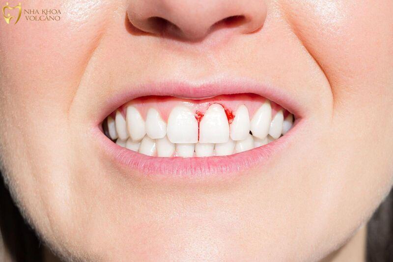 Những lưu ý khi bị sưng nướu răng