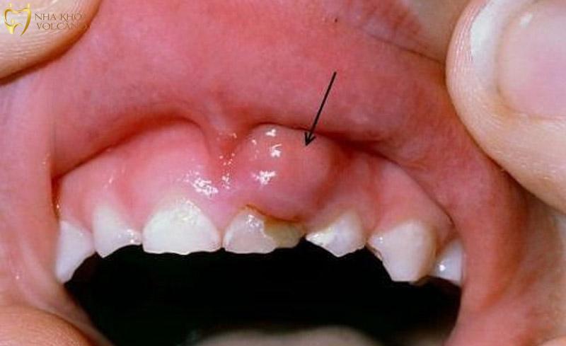 Cách điều trị sưng nướu răng có mủ