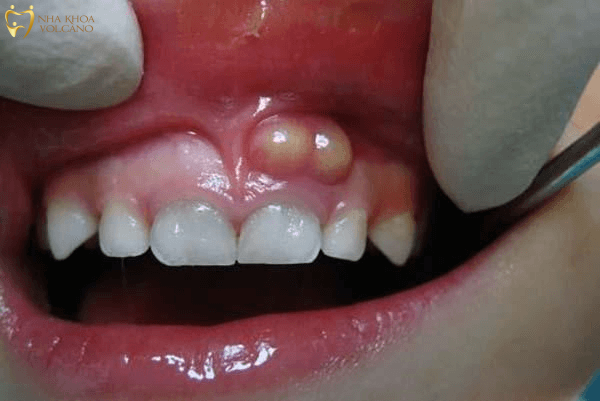 Sưng nướu răng có nguy hiểm không?