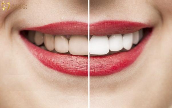 Tẩy trắng răng có bị vàng lại không?