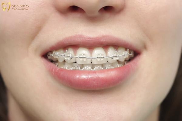 Khi tốc độ niềng răng được đặt lên hàng đầu, đôi khi chất lượng điều trị có thể bị ảnh hưởng