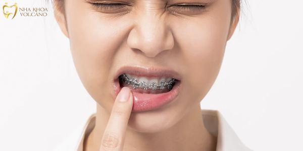 Kỹ thuật niềng răng sai cách có thể gây ra những vấn đề nghiêm trọng