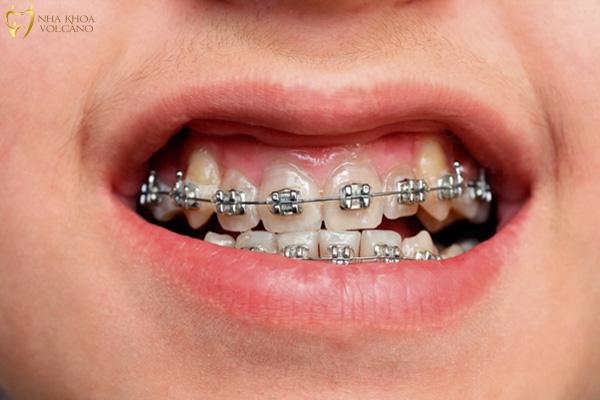 Niềng răng bị bật chân răng không chỉ tạo ra vấn đề về thẩm mỹ mà còn mang theo những tác hại nghiêm trọng
