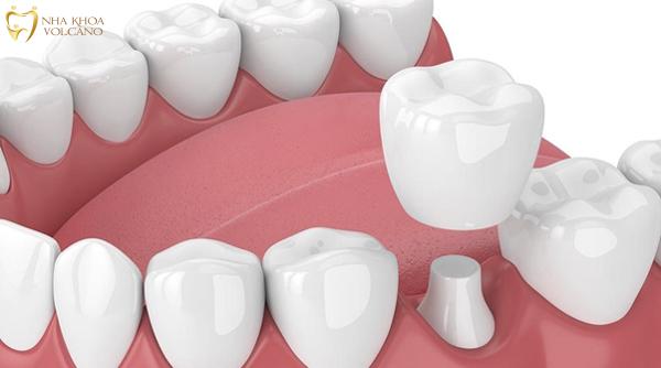 Trồng răng sứ thẩm mỹ để khắc phục tình trạng răng bị hô