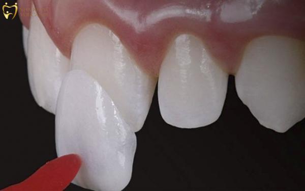 Đắp răng sứ: Tất tần tật những điều bạn cần biết trước khi quyết định