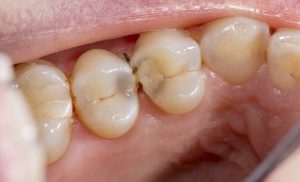 Điều trị kẽ răng bị hôi hiệu quả với những phương pháp tự nhiên