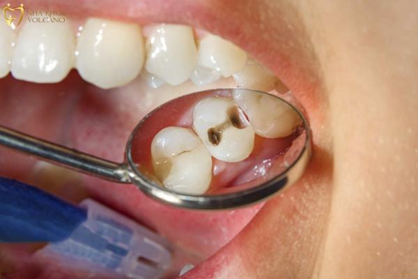 Lấy tủy răng có đau không? Tìm hiểu sự thật từ khách hàng đã trải nghiệm Lấy tủy răng có đau không là một trong những câu hỏi mà nhiều người quan tâm khi phải đối mặt