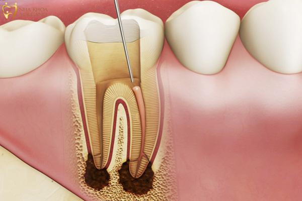 Lấy tủy răng có đau không? Tìm hiểu sự thật từ khách hàng đã trải nghiệm