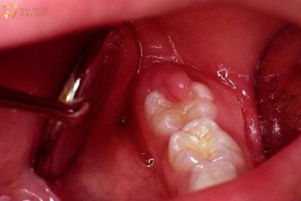 Viêm nhiễm và nhiễm trùng