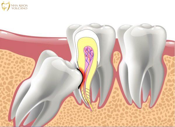 Mọc răng khôn có những nguy hiểm gì?