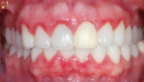 Viêm lợi sau khi bọc răng sứ là một vấn đề mà nhiều bệnh nhân phải đối mặt