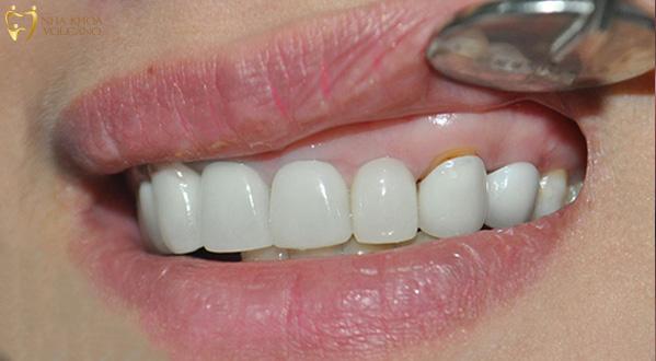 Răng sứ bị hở, cong vênh là một tình trạng khó chịu mà nhiều người bắt gặp sau khi lắp răng sứ