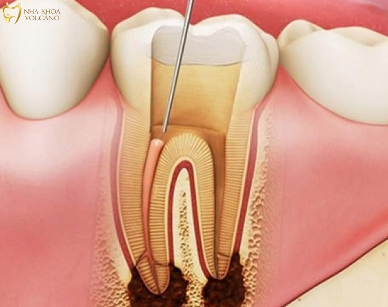 Tại sao phải lấy tủy răng
