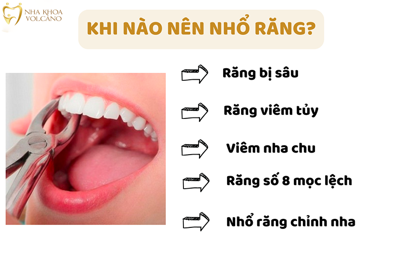 Khi nào nên nhổ răng?