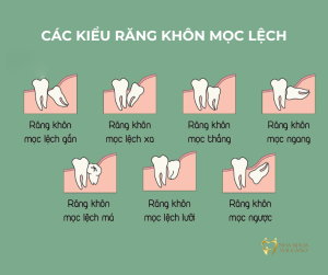 Răng khôn mọc lệch