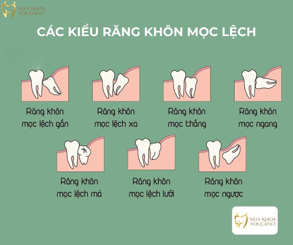 răng khôn