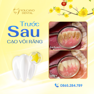 5 ĐỊA CHỈ LẤY CAO RĂNG UY TÍN TẠI DĨ AN - BÌNH DƯƠNG Lấy cao răng