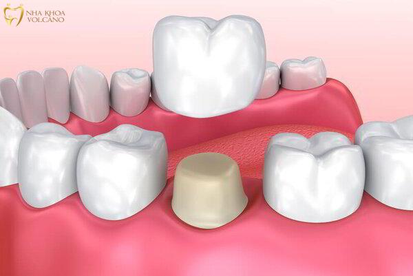 Bọc răng sứ bị lệch khớp cắn phải làm sao? Có nguy hiểm? Mão răng không khớp với răng thật gây nên tình trạng lệch khớp cắn