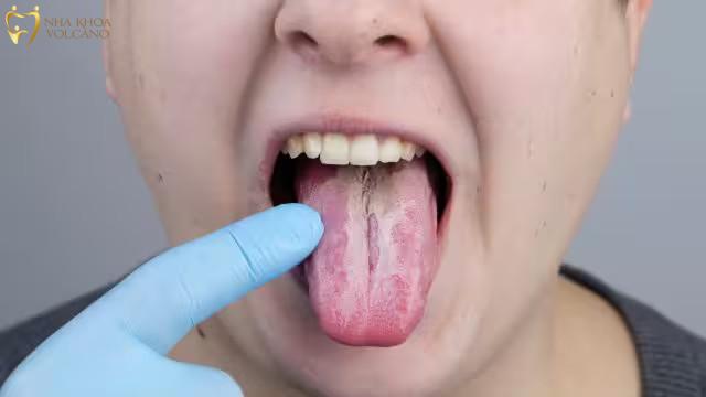 Có rất nhiều nguyên nhân dẫn đến tình trạng lưỡi nổi hột