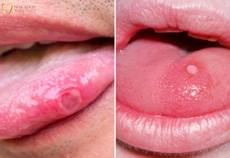 Sùi mào gà là một bệnh lây truyền qua đường tình dục khá phổ biến, do virus HPV gây nên