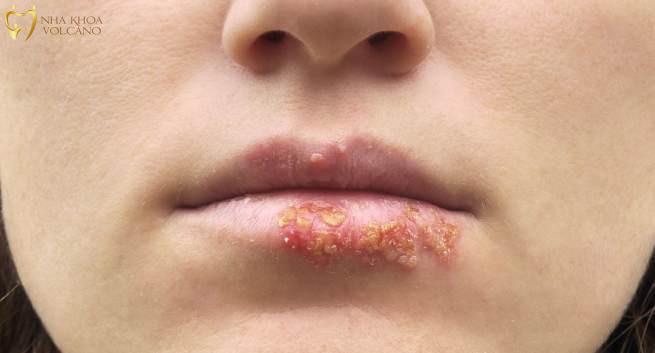 Mụn rộp sinh dục