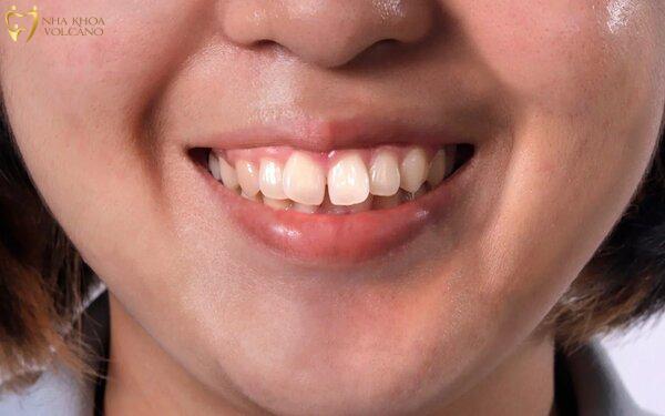 Mài răng với trường hợp răng cửa xô lệch, hô nhẹ