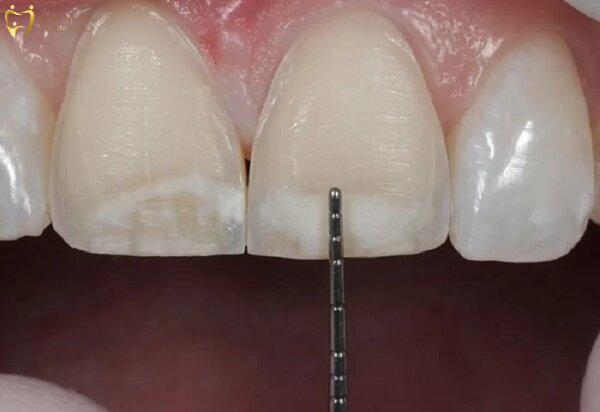 Mài răng cửa để cải thiện tính thẩm mỹ và chức năng ăn nhai