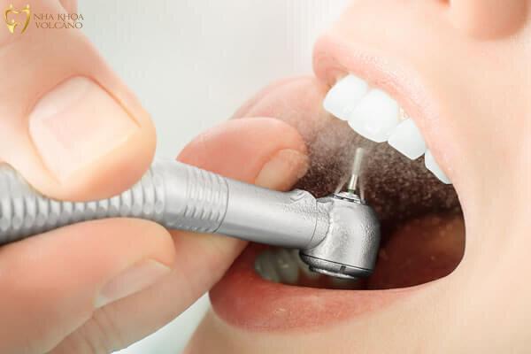 Quá trình mài răng không gây đau đớn