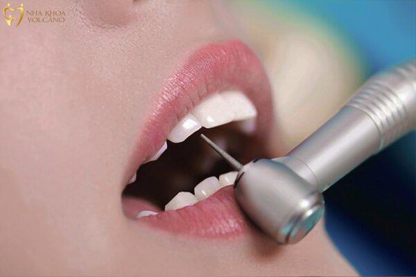 Mài nhỏ răng cửa là phương pháp thẩm mỹ nha khoa phổ biến