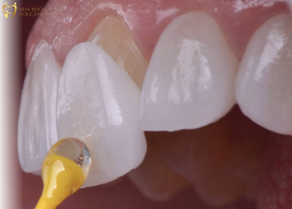 Tiến hành bọc sứ để bảo vệ răng thật