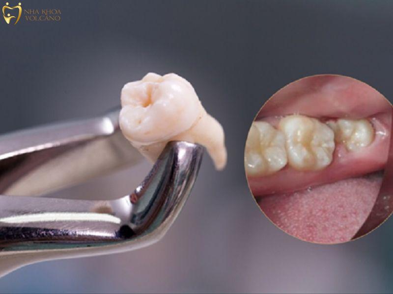 Răng khôn mọc mấy lần?