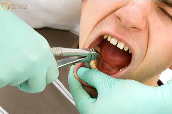 Nên nhổ răng khôn ở bệnh viện hay phòng khám?
