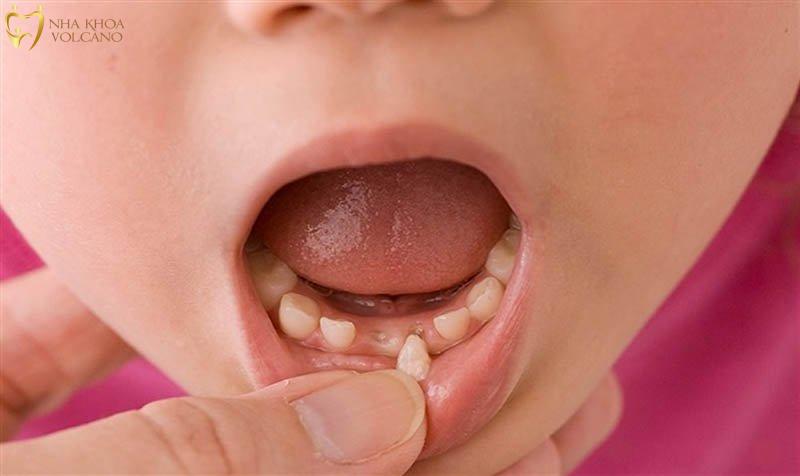 Răng sữa mọc lệch có làm ảnh hưởng răng vĩnh viễn không?