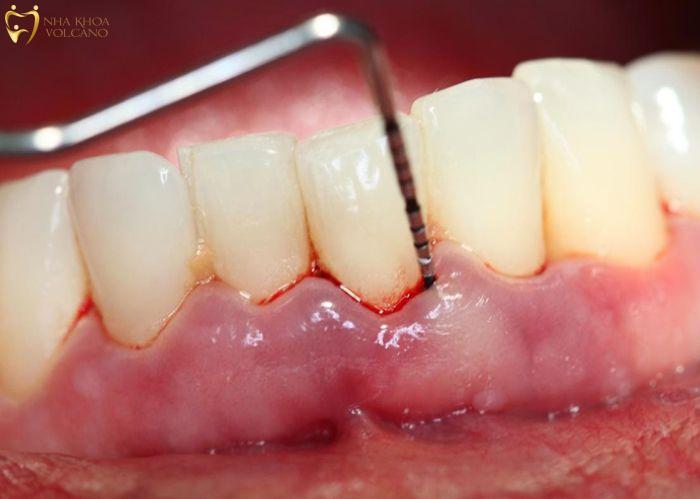 Viêm quanh răng là một trong những nguyên nhân hàng đầu dẫn đến tình trạng viêm chân răng có mủ