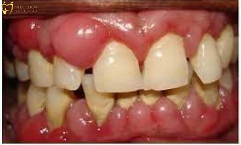 Viêm lợi có mủ phải làm sao?