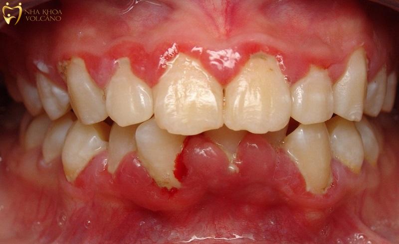 Viêm chân răng có mủ là gì?