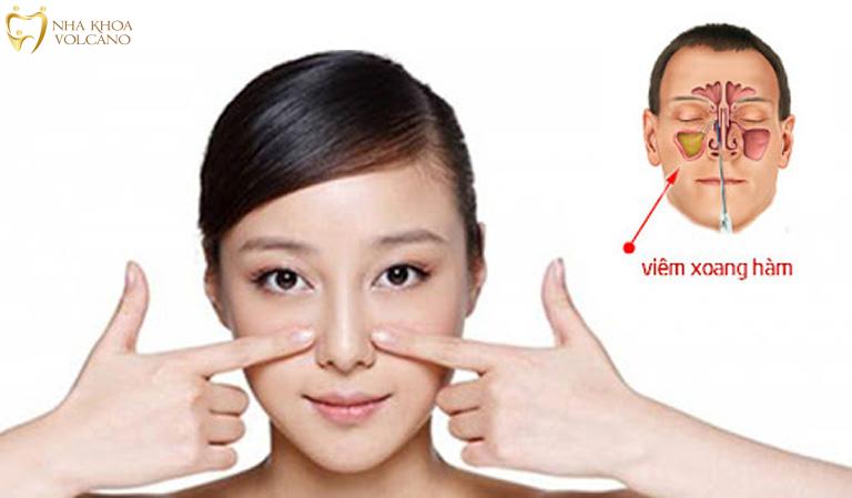 Có nhiều yếu tố và bệnh lý có thể dẫn đến tình trạng viêm xoang hàm
