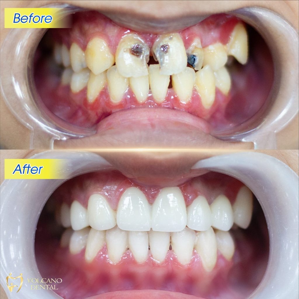 PHỤC HÌNH RĂNG SỨ UY TÍN TẠI DĨ AN, BÌNH DƯƠNG