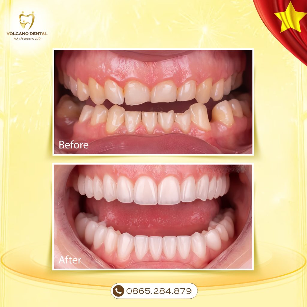 PHỤC HÌNH RĂNG SỨ UY TÍN TẠI DĨ AN, BÌNH DƯƠNG