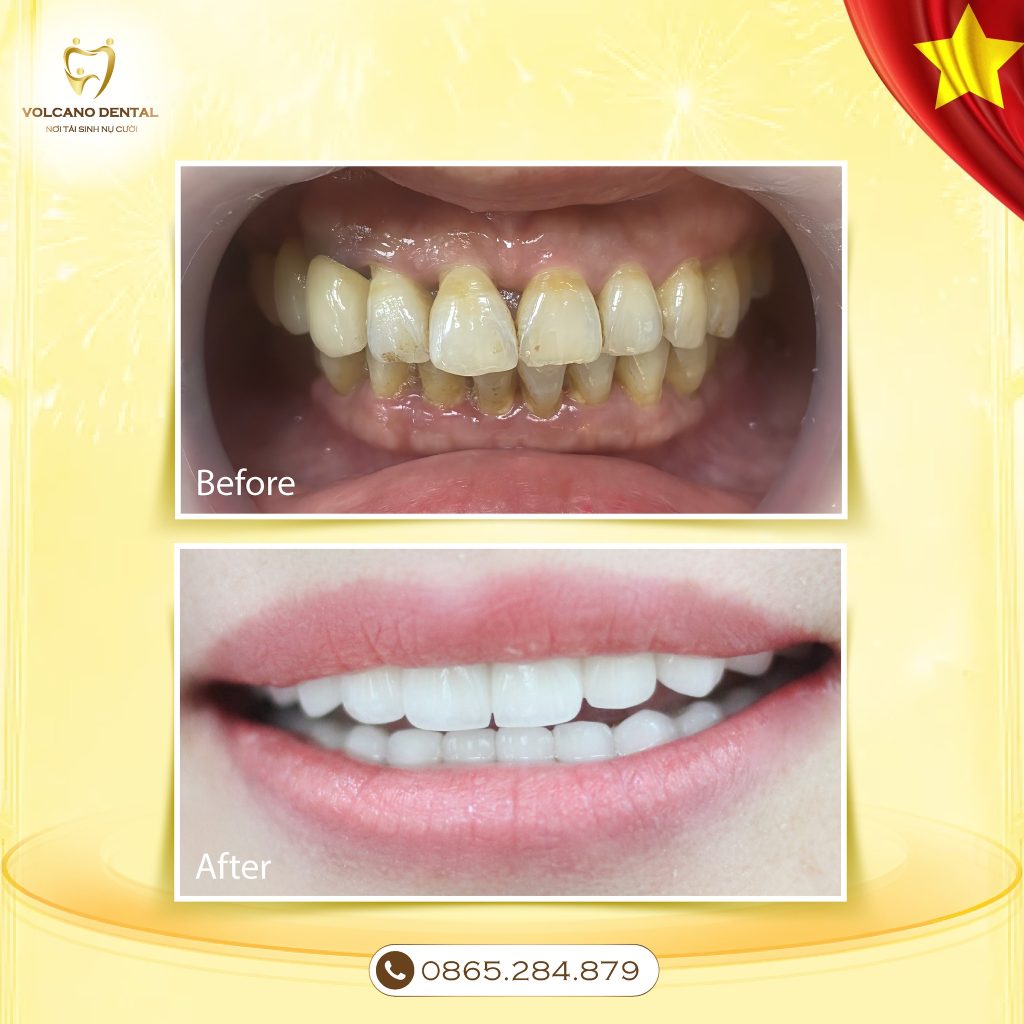 PHỤC HÌNH RĂNG SỨ UY TÍN TẠI DĨ AN, BÌNH DƯƠNG