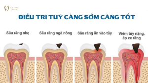 lấy tủy răng