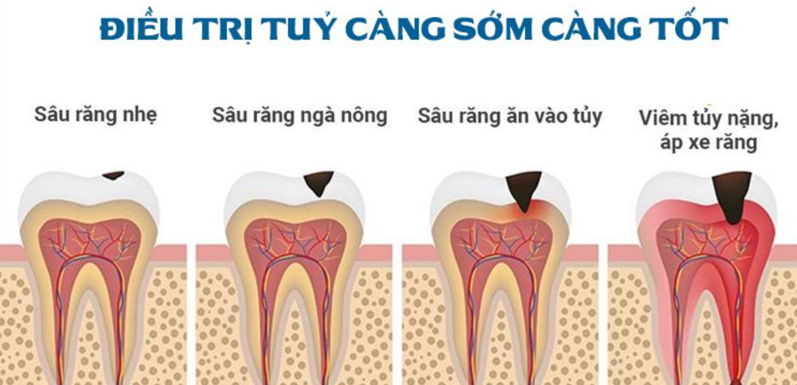 lấy tủy răng