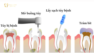 Lấy tủy răng